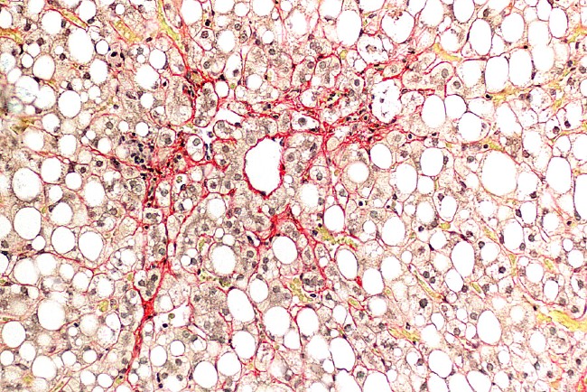 Steatohepatitis picro sirius