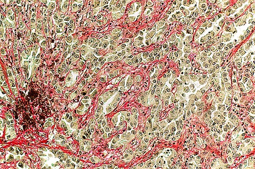 Hepatocellular carcinoma picro sirius